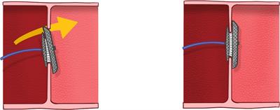 Novel technique to reduce prolapsed device in atrial septal defect closure